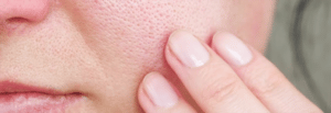 Hvad er poret hud